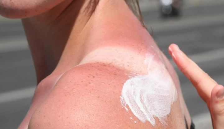 Никакой сметаны, лопухов и «чайного гриба»: чем категорически запрещено лечить солнечные ожоги