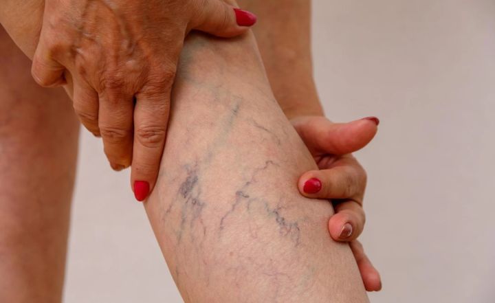 Смертельные тромбы: как сохранить сосуды и избежать преждевременной кончины