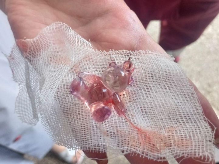 В Стаханове врачи спасли младенца, который чуть не задохнулся из-за брелока