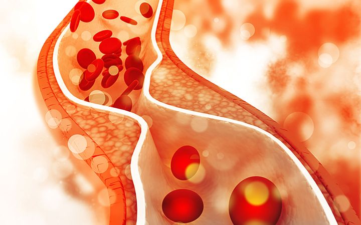Российские учёные разработали полимер, который защищает от инсультов