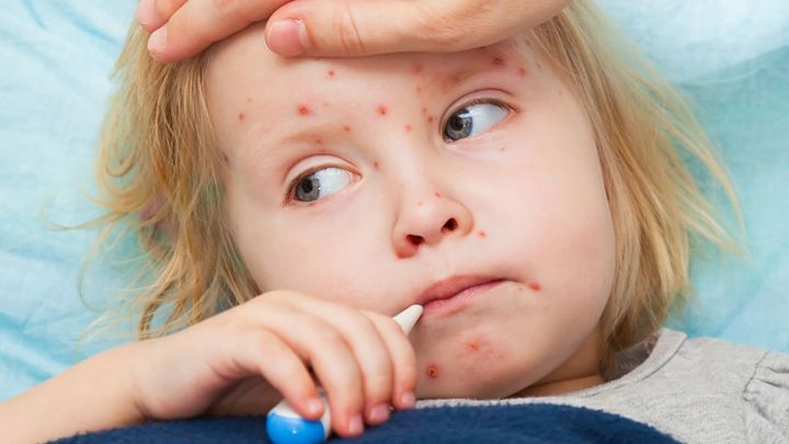 Распространяется ли в ЛНР самая опасная детская болезнь - корь?