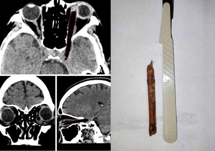 Россиянка ходила с восьмисантиметровой веткой в глазу две недели, пока она не загноилась