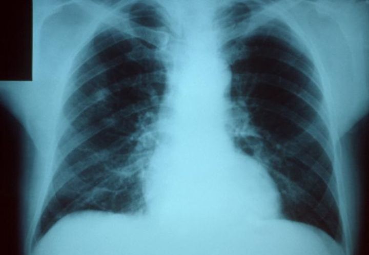 В Свердловске фиксируют рост заболеваемости пневмонией