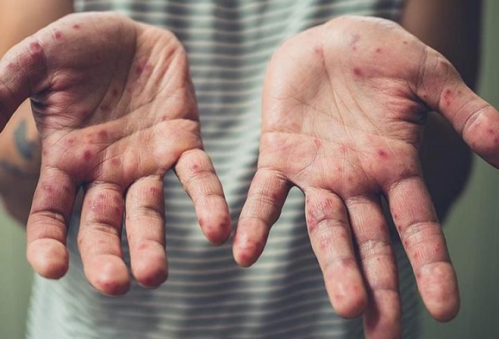 Симптомы похожи на ОРВИ: специалисты рассказали, как не спутать корь с другими болезнями