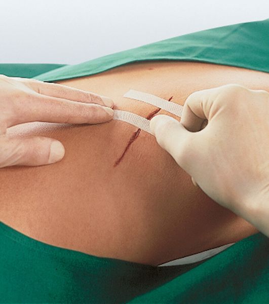 «Умные» швы смогут облегчить состояние пациентов после операции